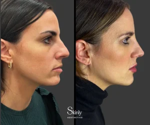 Before and after chin injections showing enhanced chin projection.
