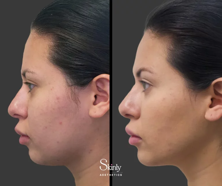 Before and after chin filler on a female showing improved chin contour.