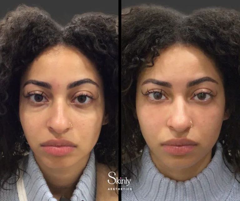 Before and after under eye filler treatment, showing reduced dark circles.