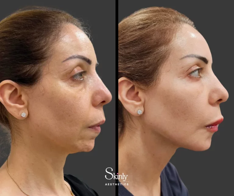 Profile view of before and after liquid facelift, showing lifted cheeks and jawline.