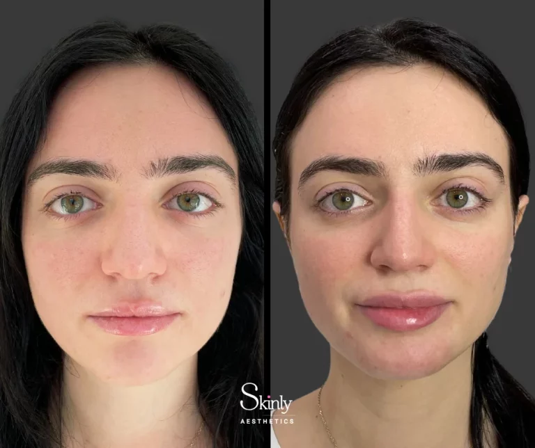 Before and after dermal filler in the lips for improved shape.