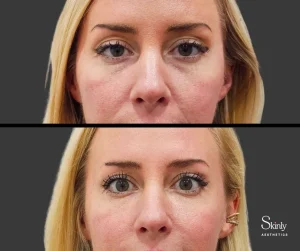 Before and after filler treatment for under eye bags.