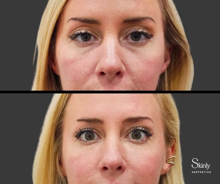 Before and after filler treatment for under eye bags.