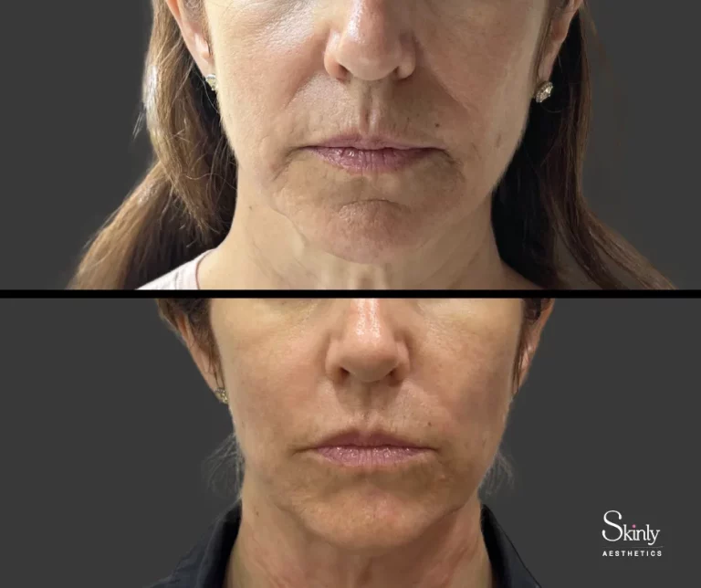 Before and after filler for laugh lines, showing rejuvenated midface.