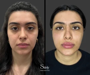Before and after filler for smile lines, showing softened facial folds.