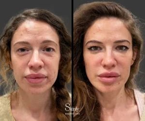 Before and after forehead filler showing reduced deep static wrinkles.