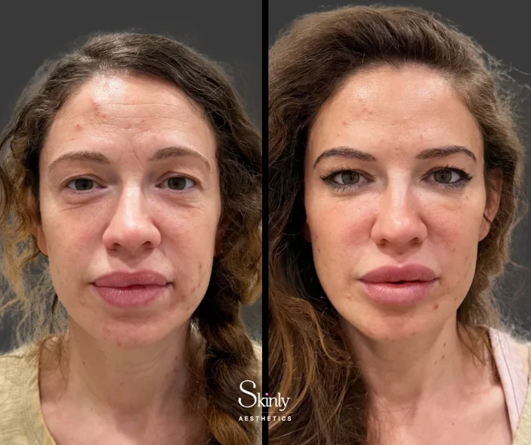 Before and after forehead filler showing reduced deep static wrinkles.