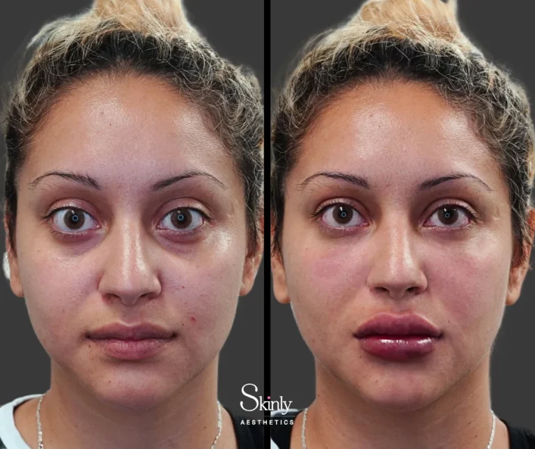 Before and after lip filler showing poutier lips.
