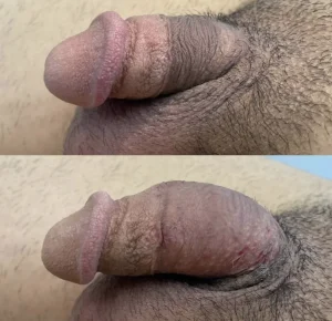 Before and after girth enhancement with filler, showing fuller penis.