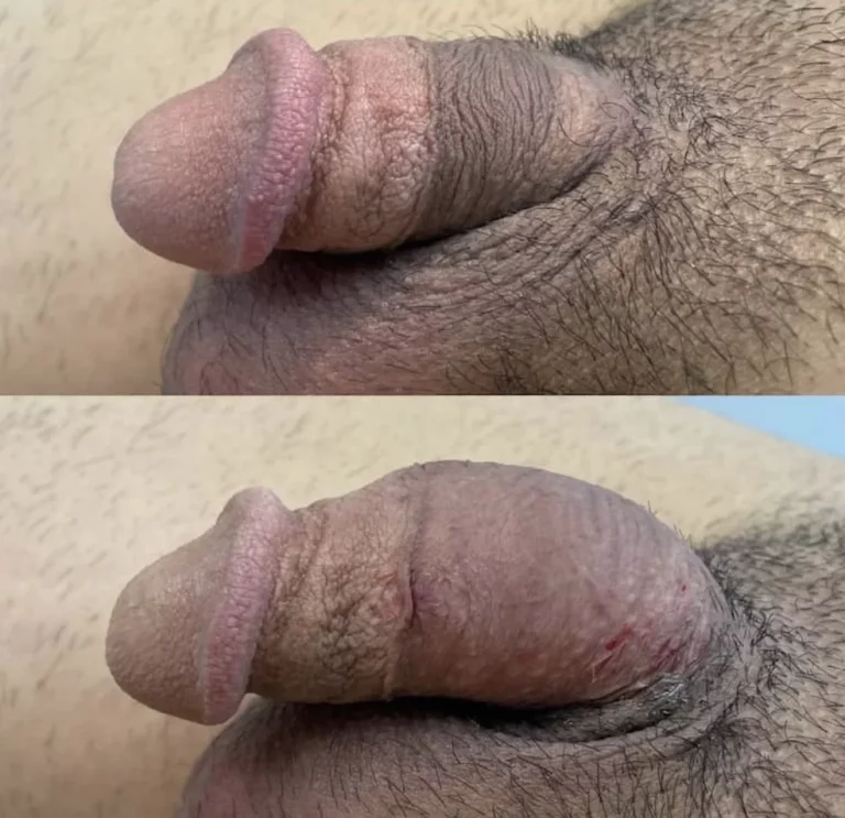 Before and after girth enhancement with filler, showing fuller penis.