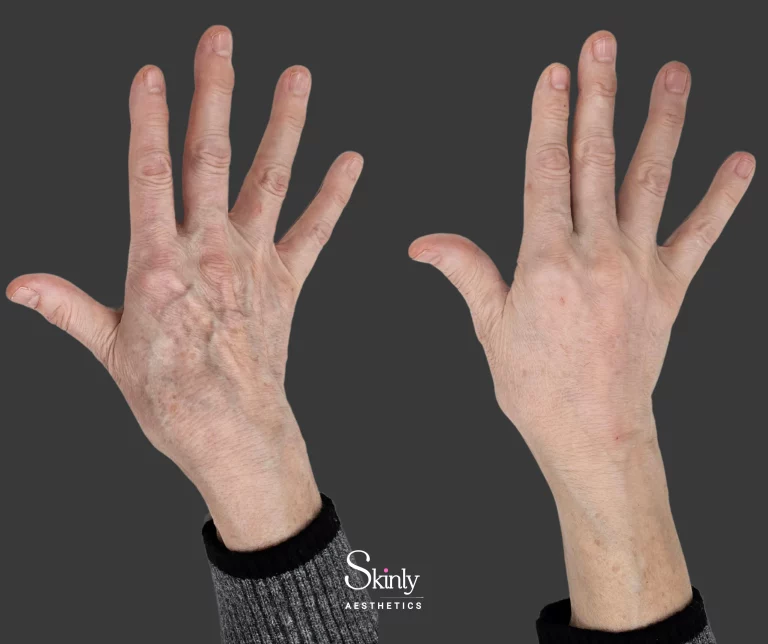 Hand filler before and after – Radiesse & RHA, immediate results