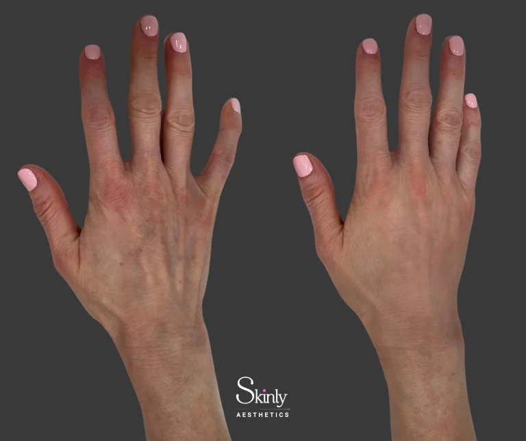 Hand filler before and after – Restylane + Radiesse combination, immediate improvement