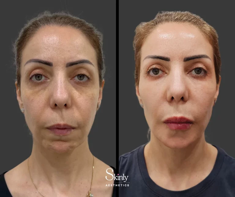 Before and after cheek filler showing enhanced high cheekbones.