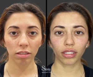 Before and after under eye injections, showing reduced hollowness.