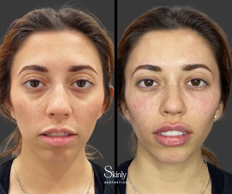 Before and after under eye injections, showing reduced hollowness.
