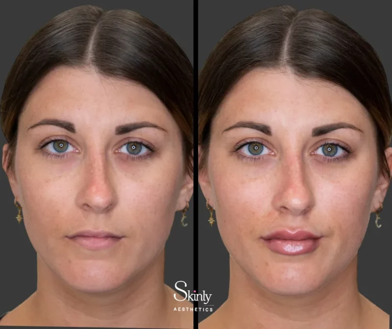 Before and after hyaluronic acid lip filler showing fuller lips.