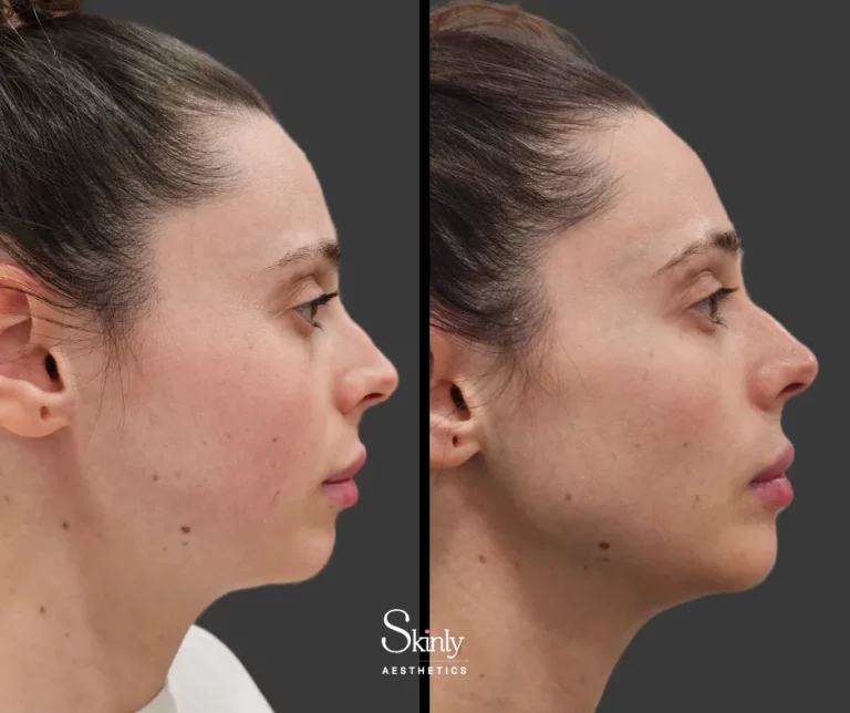 Before and after jawline filler, showing increased jaw definition.