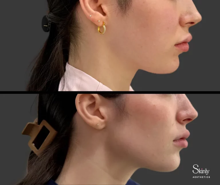 Before and after jawline filler, showing improved definition.