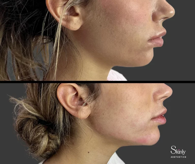 Before and after jawline filler for enhanced facial contour.