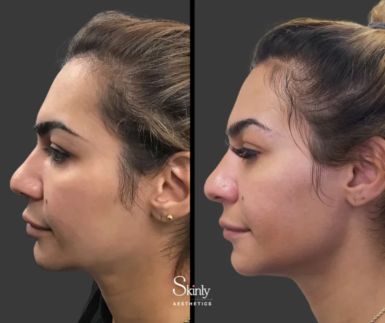 Female patient side profile before and after jawline filler.