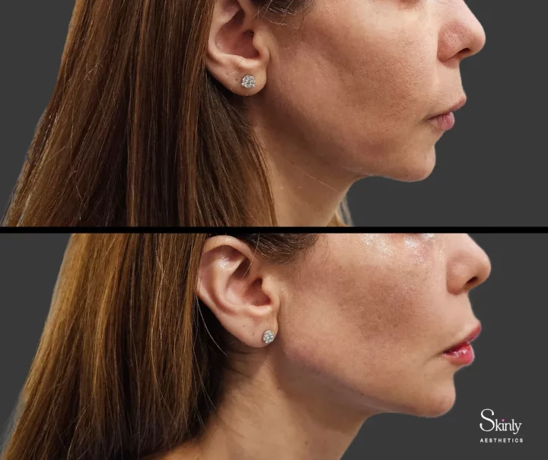 Before and after jawline filler showing improved contour to the jawline.