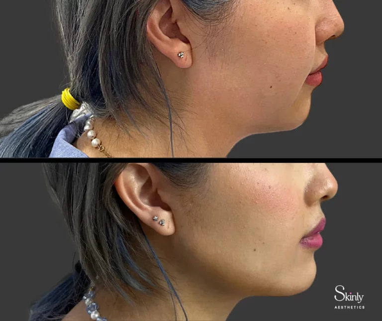 Before and after jawline filler, showing improved contour.