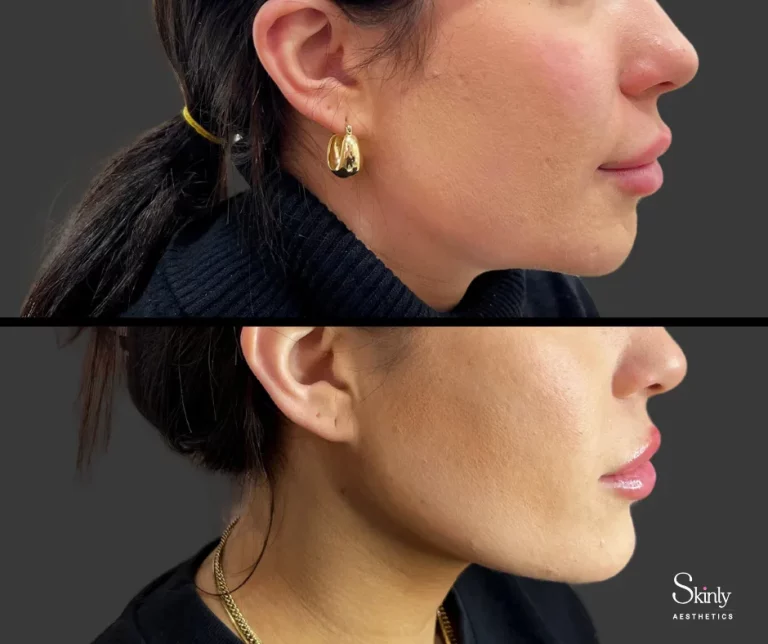Before and after jawline filler showing enhanced jawline definition.