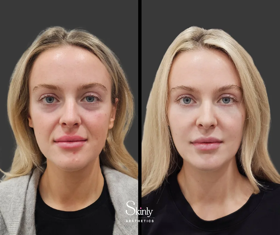 Before and after results following cheek augmentation by Dr. Schwarzburg in NYC