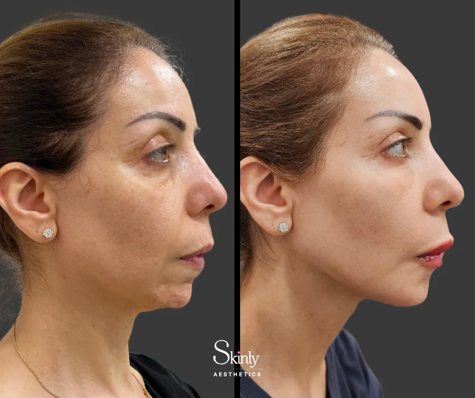 Juvederm Volux Before and After results showing lifted and contoured jawline