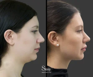 Reducing double chin fullness after Kybella injections - before (left) vs after (right) in NYC.