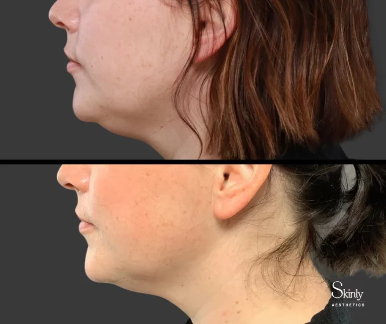 Before and after Kybella double chin removal, showing slimmer chin.