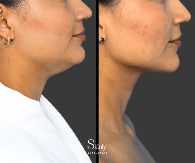 Before and after Kybella injections, showing contoured jawline.