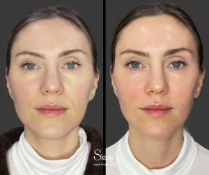 Before and after laugh line filler, showing reduced facial folds.