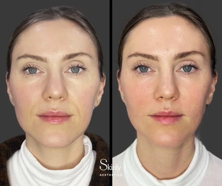 Before and after laugh line filler, showing reduced facial folds.