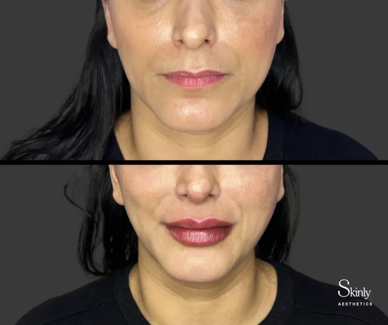 Before and after lip augmentation showing fuller lips.
