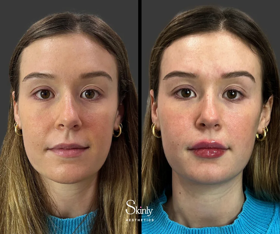 Natural lip enhancement with dermal filler by Dr. Schwarzburg