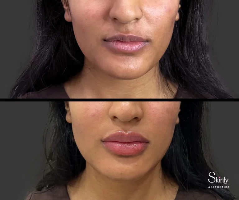 Before and after lip filler showing refined lip contour.
