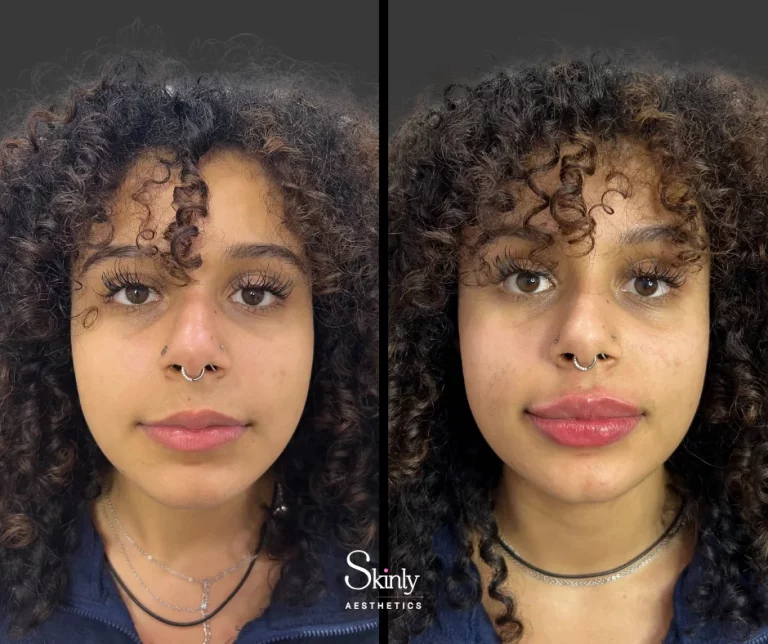 Before and after lip contouring with filler, showing balanced lip proportions.