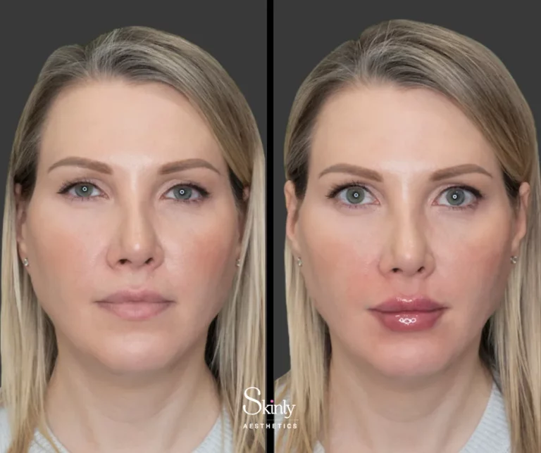 Before and after lip filler for a natural enhancement.