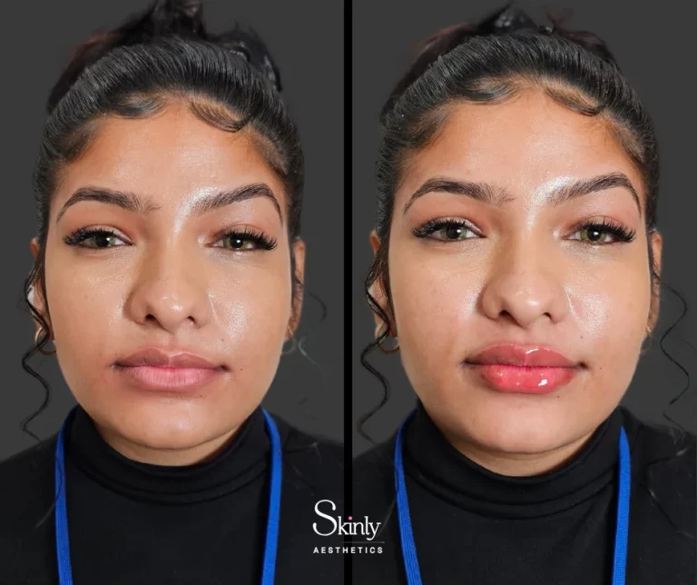 Before and after lip filler for volume enhancement.