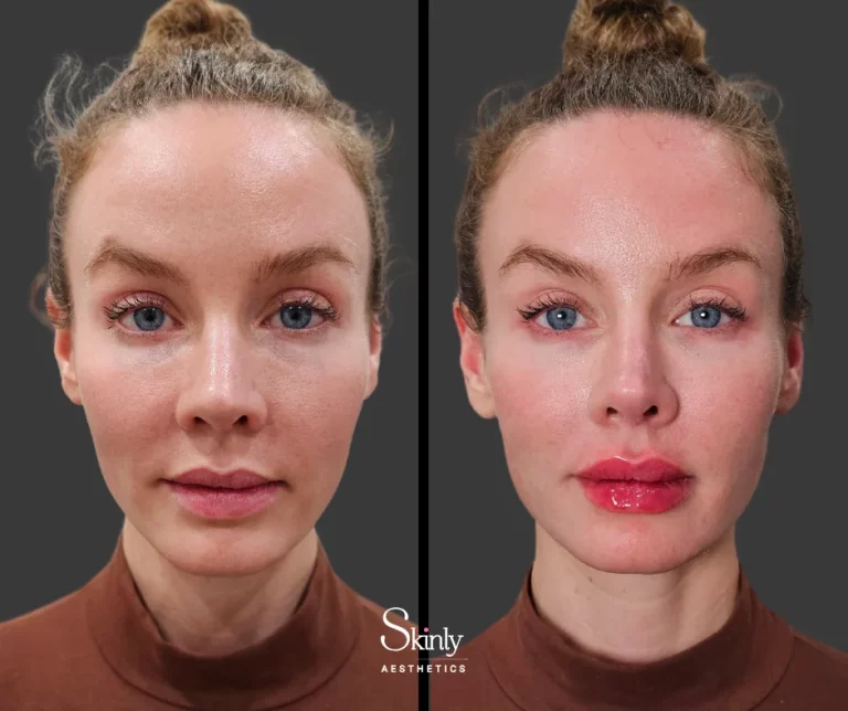 Before and after lip filler showing added fullness.
