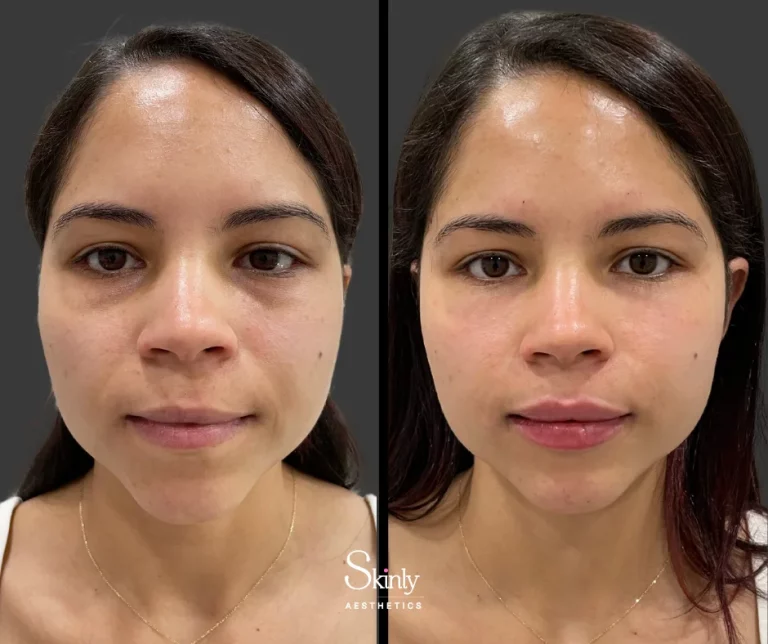 Before and after lip filler showing natural lip shape.