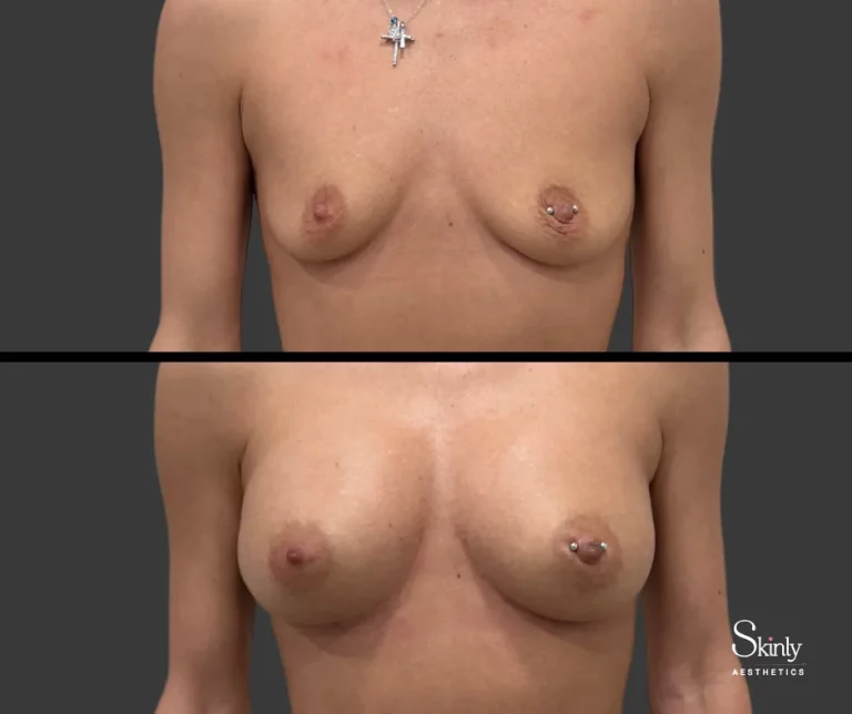 Liquid breast lift before and after, showing fuller breasts.