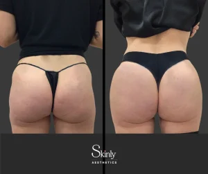 Before and after liquid butt lift showing improved contours
