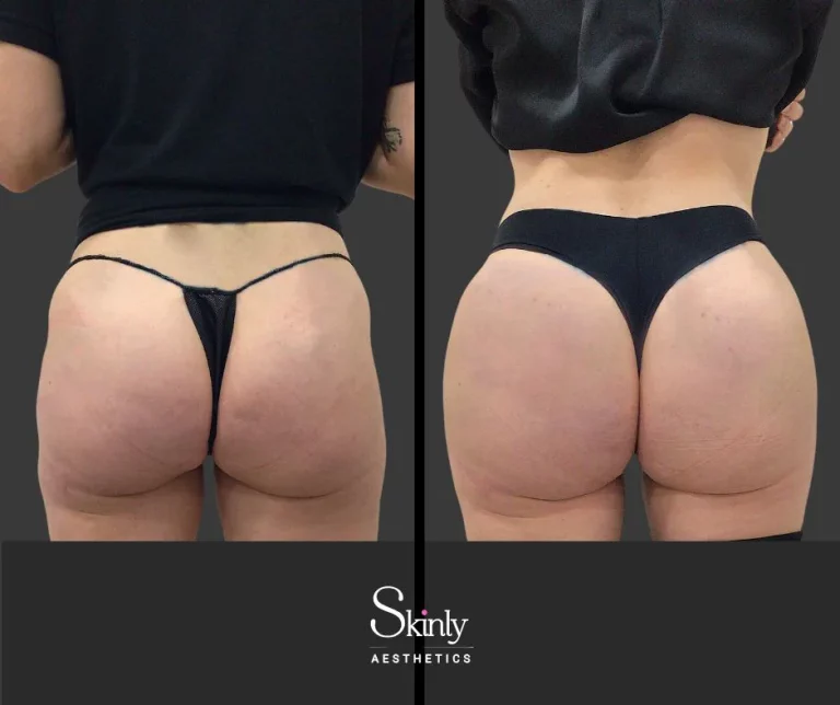 Before and after liquid butt lift showing improved contours