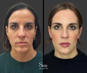 Before and after liquid facelift, showing restored facial volume.