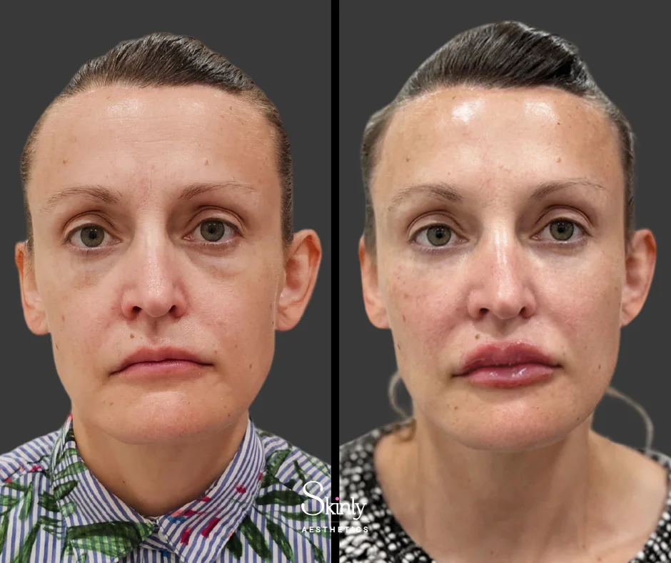 Before and after results following liquid facelift with facial fillers by Dr. Schwarzburg