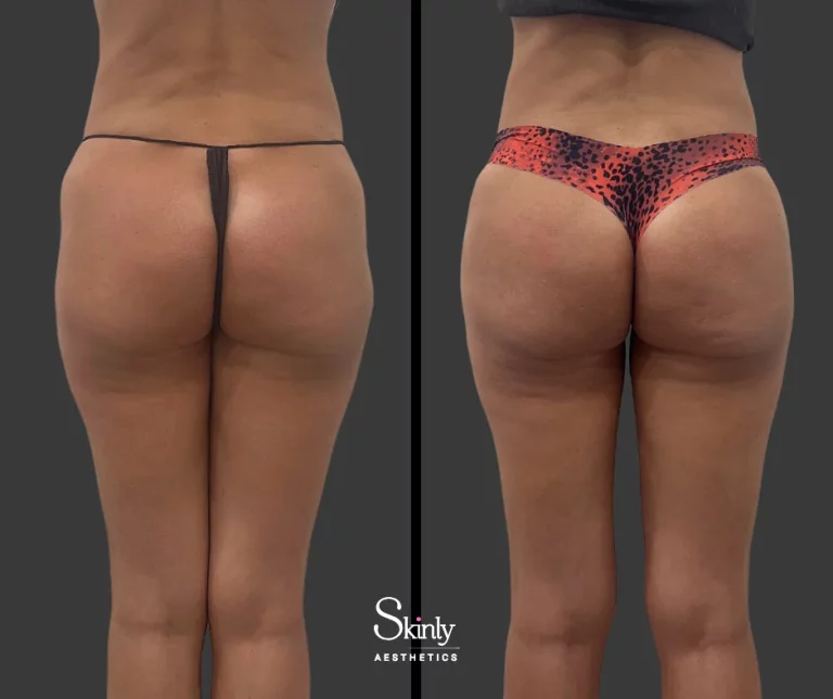 Before and after liquid hip dip correction showing balanced hips.