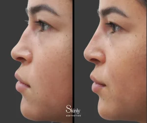 Before and after nose filler, showing smoothed out dorsal hump.
