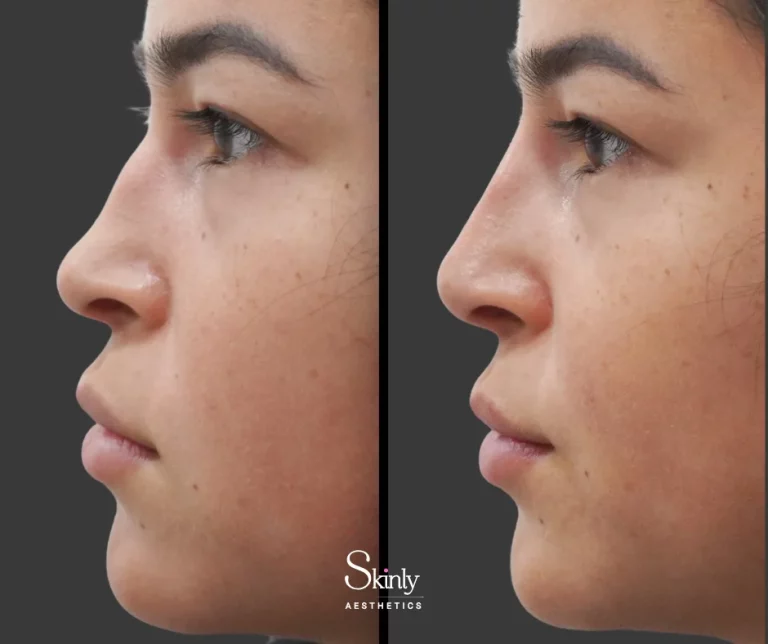 Before and after nose filler, showing smoothed out dorsal hump.